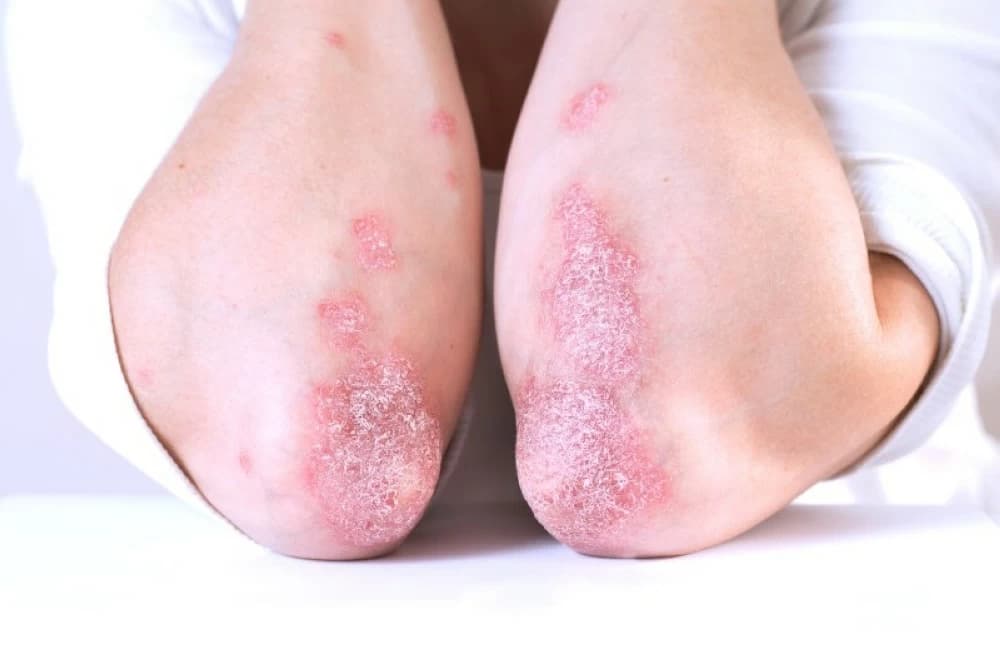 الصدفية: مرض جلدي مزمن يتطلب الوعي والعناية المستمرة